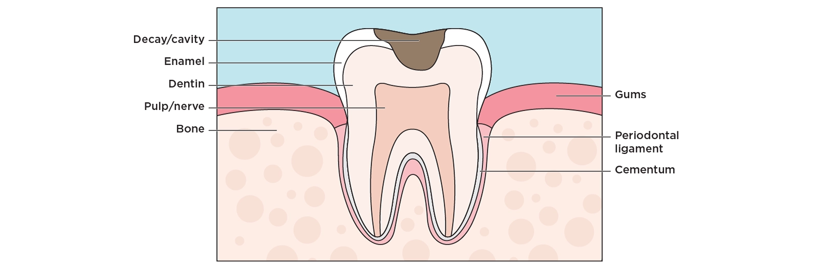 Illustration of a cross section of a tooth with a cavity in the top of the enamel and dentin