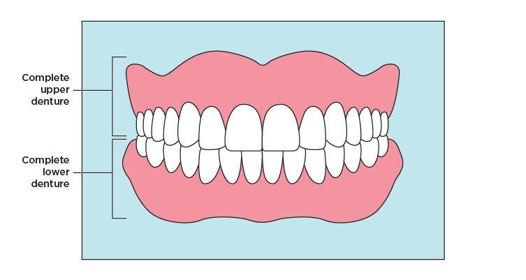 Illustration showing how partial dentures leave room for your healthy teeth
