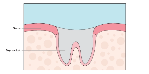 Illustration showing the spot in the gums where a tooth was pulled and is now a dry socket