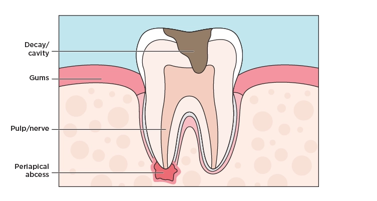Illustration of a cross section of a tooth with a deep cavity in the pulp causing an abscess at the root