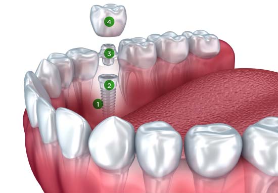 9503-5_Implants-DiagramNo-550x382.jpg