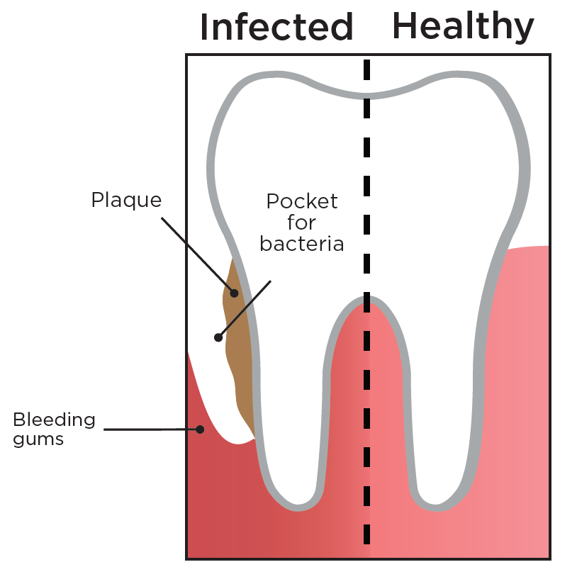 What is a periodontal exam? Delta Dental