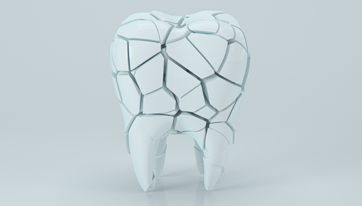 Cracked tooth types of tooth fractures